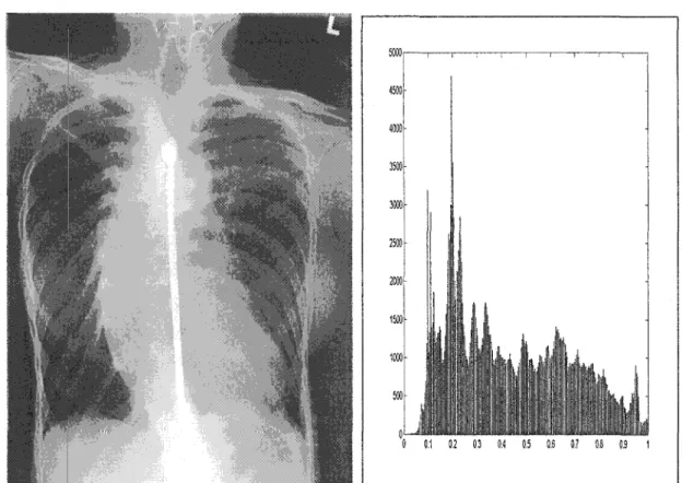 Figure 7  Radiographie  à  rayons X et son histogramme 