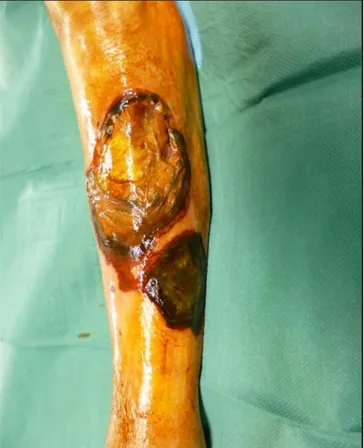Figure 5a. DHBN-FN d'un membre inférieur à un stade tardif (pré- (pré-opératoire) chez une patiente de 91 ans souffrant d’insuffisance  rénale modérée et d’HTA : placard de nécrose cutanée, bulles  hémorragiques sur fond d’œdème et d’érythème (collection  
