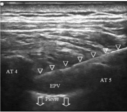 fig 12 : Refoulement de la plèvre après injection en coupe parasagittale dans l'EPV   (Espace Paravertébral) (102)