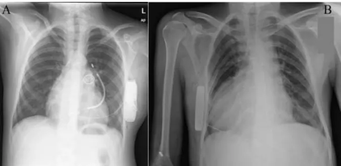 Figure 8. RT de deux jeunes patients implantés avec un DAI sous-cutané. 