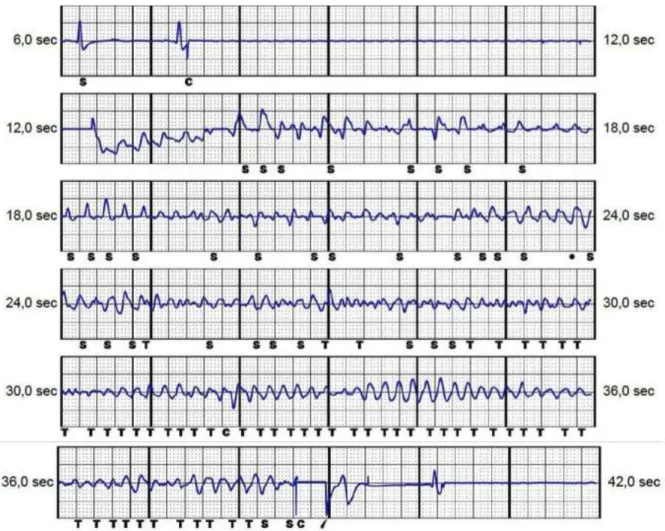 Figure  10A.  Durant  l’implantation,  induction  d’une  arythmie  ventriculaire  avec  un  retard important de détection (sous-détection évidente des signaux fibrillatoires) ; l’arythmie  est finalement détectée, conduisant à un choc délivré 25 secondes a