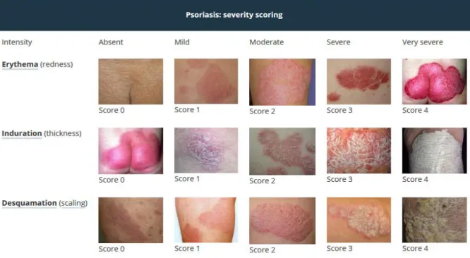 Figure 8. Score PASI (Psoriasis Area Severity Index).  (site https://www.dermnetnz.org/topics/pasi-score/)