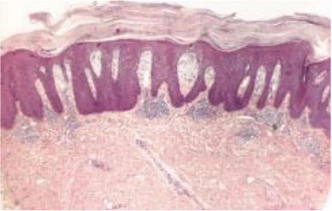 Figure  11.  Composants  d’une  plaque  de  psoriasis  par  rapport  à  la  peau  saine 