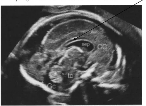 Figure 5 : Coupe sagittale médiane à 22SA chez un fœtus sain  corps calleux 