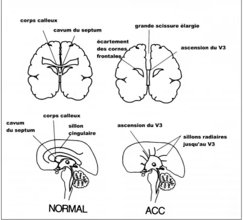 Figure 7: Représentation schématique du corps calleux et de l'ACC en coupes coronales et  sagittales