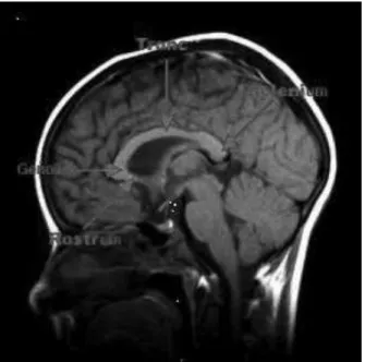 Figure 9 : Vue sagittale à l'IRM de l'encéphale : présence du corps calleux 