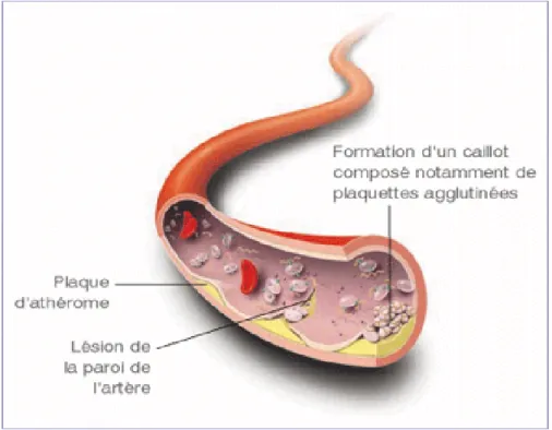 Figure 3: Histoire de la formation du thrombus  ( http://www.rtflash.fr)