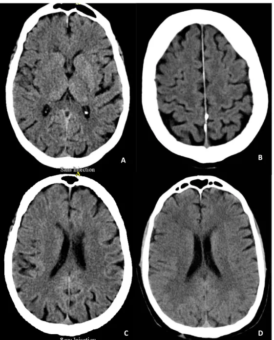 Figure 14: Effacement du noyau lenticulaire droit (A), dédifférenciation cortico sous corticale (B),  effet de masse sur le ventricule latéral droit (C) et effacement des sillons corticaux (D) (Labelle et 