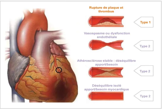 Figure 1 - Illustration de la différence entre IDM de type 1 et de type 2  selon la « Third universal  definition of myocardial infarction » (5) 