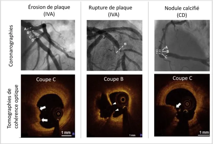 Figure  7  -  Illustration  des  trois  cas  de  disruption  de  plaques :  érosion  de  plaque  (à  gauche),   rupture de plaque (milieu) et nodule calcifié (droite)