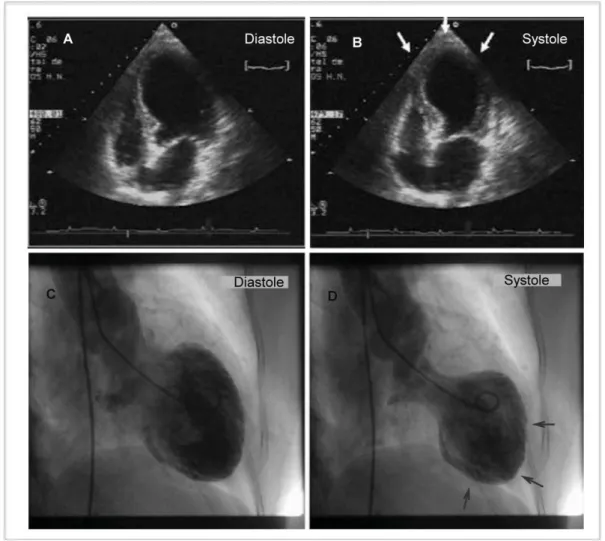 Figure  10  -  Exemples  de  deux  femmes  avec  cardiopathie  de  tako-tsubo  explorées  par  échocardiographie (A : diastole et B : systole,  Lainez et al