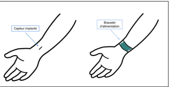 Figure 0.2 Esquisse d’implantation sous-cutanée et bracelet 