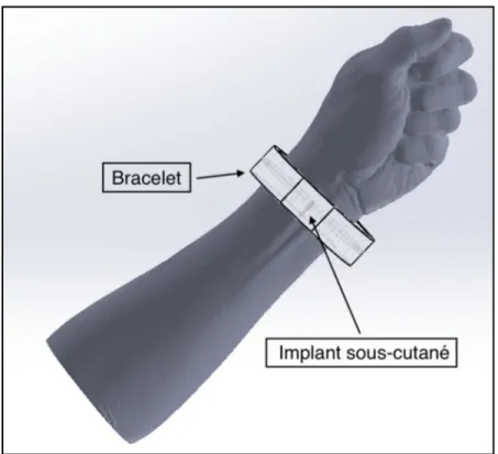 Figure 3.1 Concept du bracelet et implant appliqué sur un poignet  Modèle 3D du bras tiré de Dricketts (2017) 