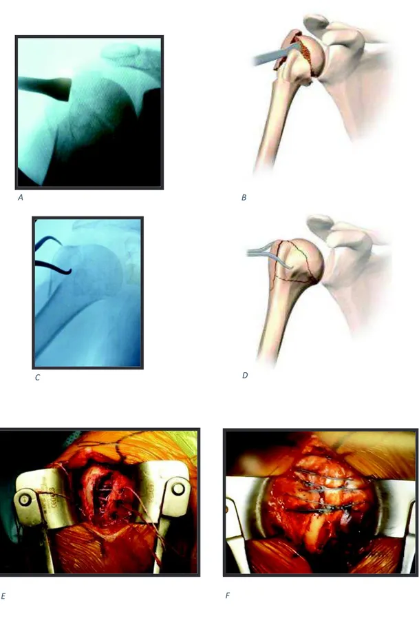 Figure 3 : Réduction de la tête humérale et des tubérosités, ostéosuture inter tubérositaire  A/B : Réduction du valgus de la tête humérale à l’aide d’un chasse greffon, C/D : réduction 