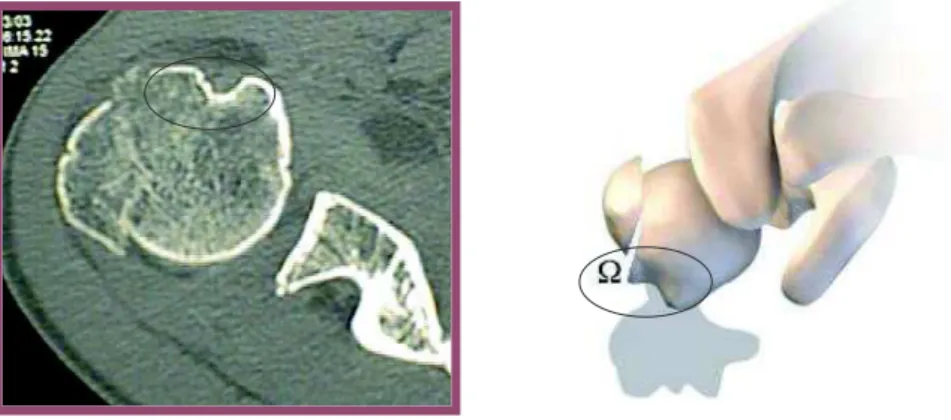 Figure 4 : Signe de l'omega positif, le trait de fracture passe en  dehors de la gouttière humérale