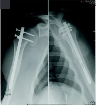 Figure 8 : A : Fracture céphalo-tubérositaire type II, B : Radiographie post opératoire à 4 mois,  glissement de la calotte céphalique, C : Radiographie post AMO plus arthrolyse