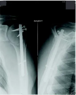 Figure 10 : A/B/C : Coupes frontales du scanner préopératoire : fracture céphalotubérositaire  type CT2