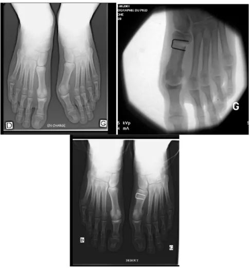 Figure 8. Hallux Valgus gauche avant la chirurgie, en per opératoire et après consolidation 