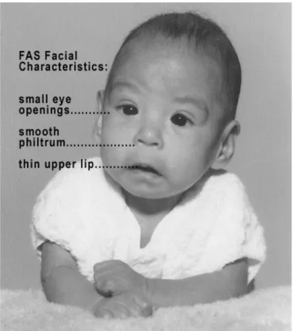Figure 1 : Enfant atteint de Syndrome d’Alcoolisation Fœtale (www.fasstar.com) 