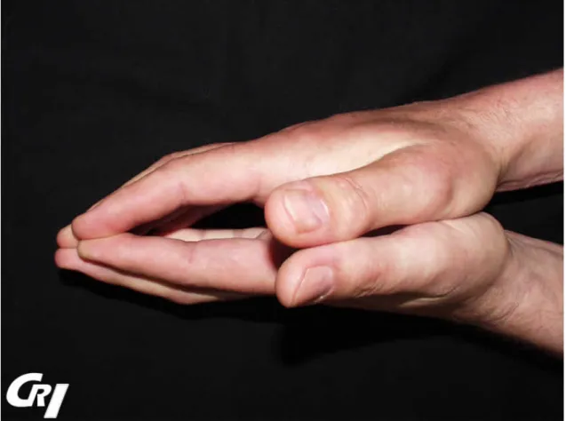 Figure 2 : Radiographies des mains et poignets de face : atteinte articulaire érosive (13) 
