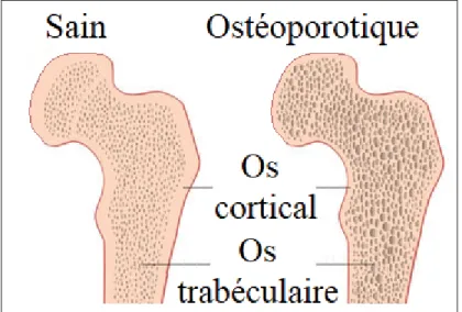 Figure 1.2 Comparaison entre un os ostéoporotique et un os sain. Adaptée de