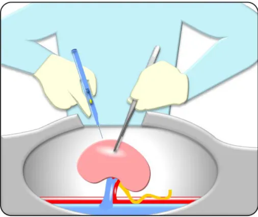 Figure 4: Schéma représentant le prélèvement de rein par chirurgie ouverte 