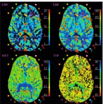 Figure 7 : Cartes fonctionnelles qualitatives obtenues avec la TDM de perfusion 