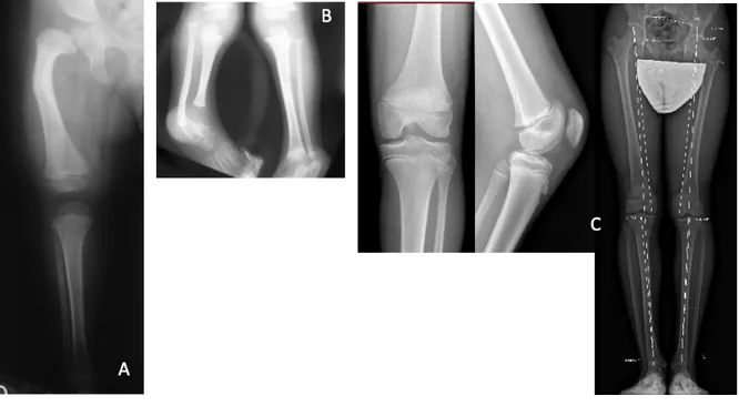 Figure 2 : A : Fémur court congénital. B : Ectromélie longitudinale interne. C : Epiphysiodèse  post-traumatique après fracture-décollement épiphysaire du fémur distal gauche.