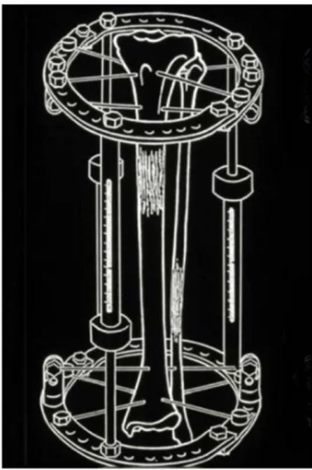 Figure 10 : Exemple de montage pour allongement tibial par méthode d’Ilizarov. 