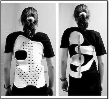 Figure 1.5   Two different braces to treat scoliosis. 