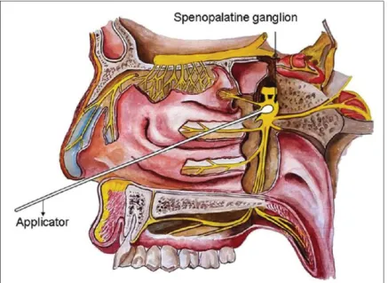 Figure 6 : Réalisation d’un bloc sphénopalatin
