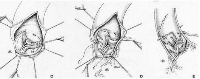 Figure 5 : Implantation en position sous coronaire. 