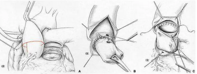 Figure 6 : Implantation intra aortique de la racine valvulaire. – Aortotomie et remplacement valvulaire
