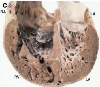 Figure 24 : Coupe histologique d’un patient porteur d’une NCVG. On retrouve deux couches  une épicardique compact (flèche) et une endocardique non compacté (tête de flèche)