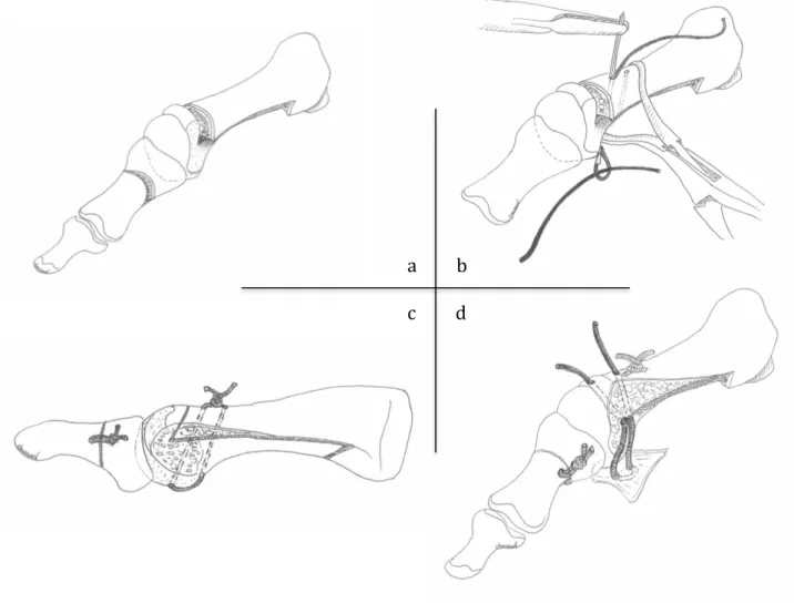 Figure 4 : Schématisation des différents temps de réalisation puis de fixation de l’ostéotomie de  scarf au fil