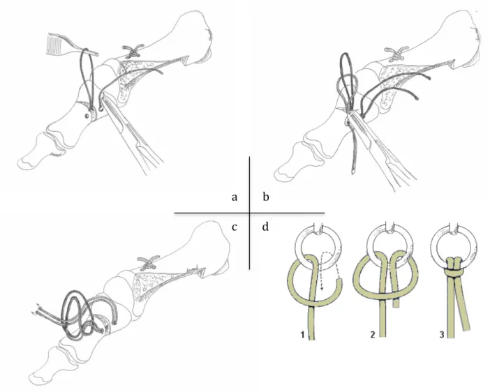 Figure 5 : Fixation au fil de l’ostéotomie phalangienne.  