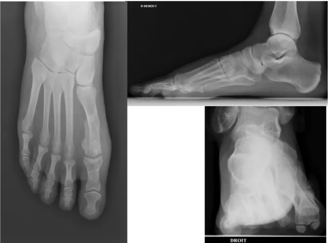Figure 10 : Patiente de 58 ans, à 3 mois post opératoire pour hallux valgus modéré secondaire, sur  pied égyptien, coté droit – groupe 2 (Fil)