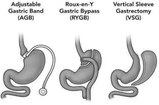 Figure 10 : les trois types de chirurgie bariatrique. 