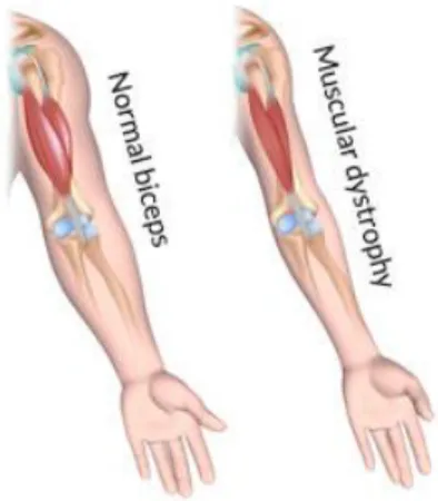 Figure 3.  Muscle sain comparé à un muscle atrophié d’un individu atteint de DM1.  