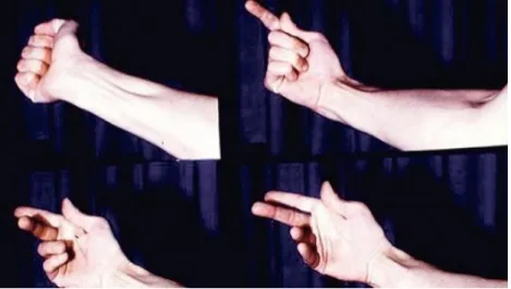 Figure 5. Photos du relâchement de la main chez un individu souffrant de myotonie. 