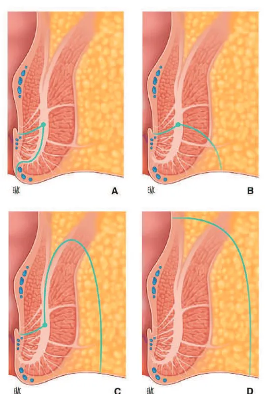 Figure 4- Classification de Parks des fistules ano périnéales  (d’après l’article  «  IRM des suppurations ano- ano-périnéales
