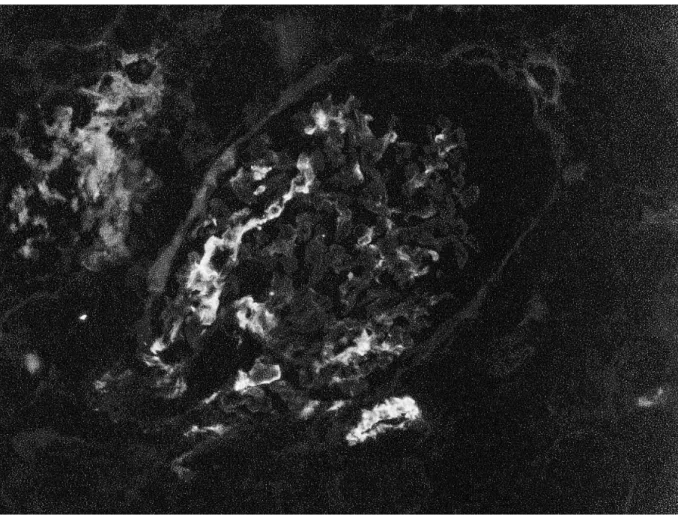 Figure 6 : fixation glomérulaire segmentaire et focale et artériolaire de l’Ac anti-  C4d en IFI, dans le rein normal