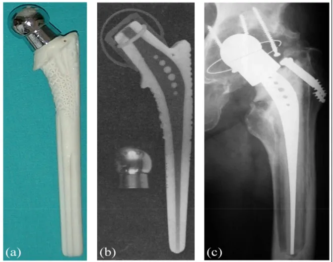 Figure 1.8 (a) Tige isoélastique, (b) Vue en coupe de la tige illustrant l’épaisseur de la couche  de polymère et de la tige centrale, (c) Radiographie illustrant l’ostéolyse à l’interface 