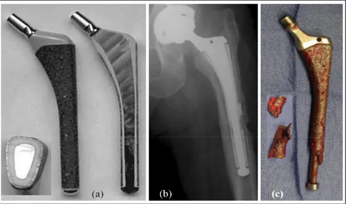 Figure 1.9 (a) Tige fémorale VerSys® Epoch® avec des coupes transversales et  longitudinales illustrant la couche polymérique et le revêtement poreux de fils métalliques, 