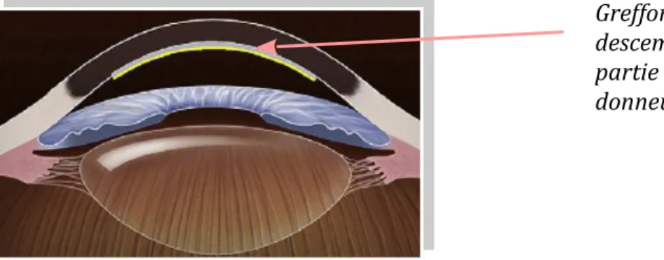 Fig. 11 – Schéma d'un greffon lors de l'utilisation de la technique DSAEK