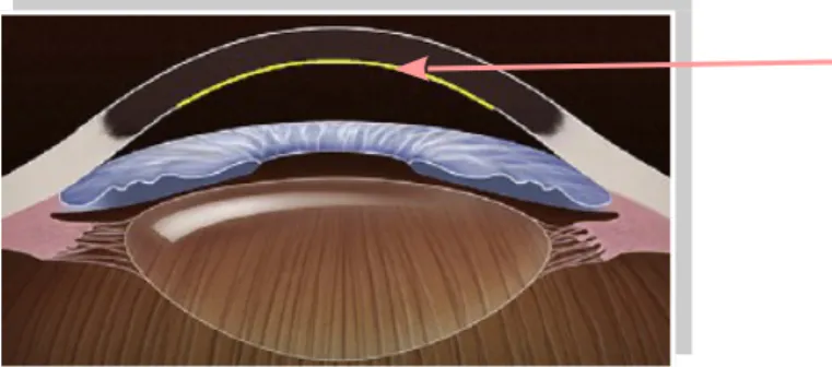 Fig. 12 – Schéma illustrant une greffon après une DMEK