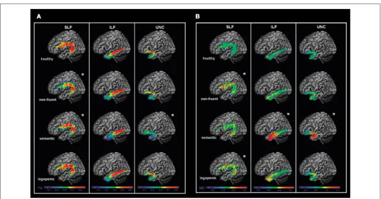 FIGURE 3 | Left language-related white matter tracts are shown in healthy controls, nfvPPA, svPPA, and lvPPA patients