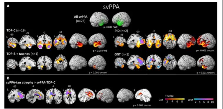 FIGURE 4 | (A) Areas of significant atrophy in a group of patients with semantic variant of primary progressive aphasia (svPPA) and subdivided by pathological subgroups