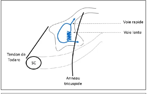 Figure  7 :  représentation  schématique  du  triangle  de  Koch.  L’influx  électrique  emprunte  la  voie  rapide  dans  le  sens  antérograde  et  la  voie  lente  dans  le  sens  rétrograde