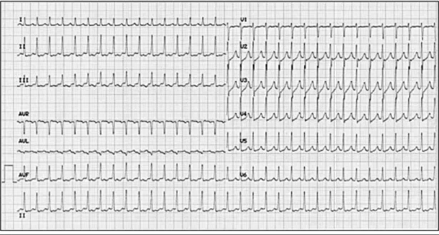 Figure 11 : Electrocardiogramme 12 dérivations de repos. Tachycardie régulière à qRS fins à 198 / min avec  espace RP’ inférieur à 70 ms
